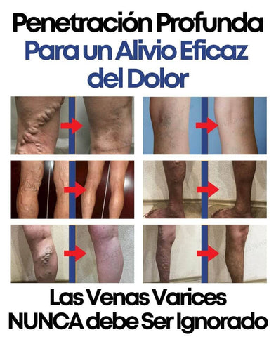 🌿 Spray South Moon⚡️ ¡Minimiza las Varices de la mejor forma! + Envío GRATiS 🚚